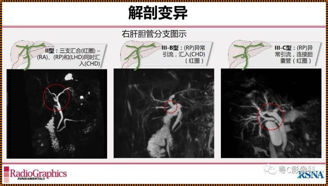 MRCP未见明显异常，究竟是不是正常？