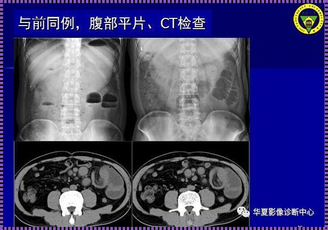 不完全性肠梗阻症状及表现：深入了解这一肠道疾病的惊人真相