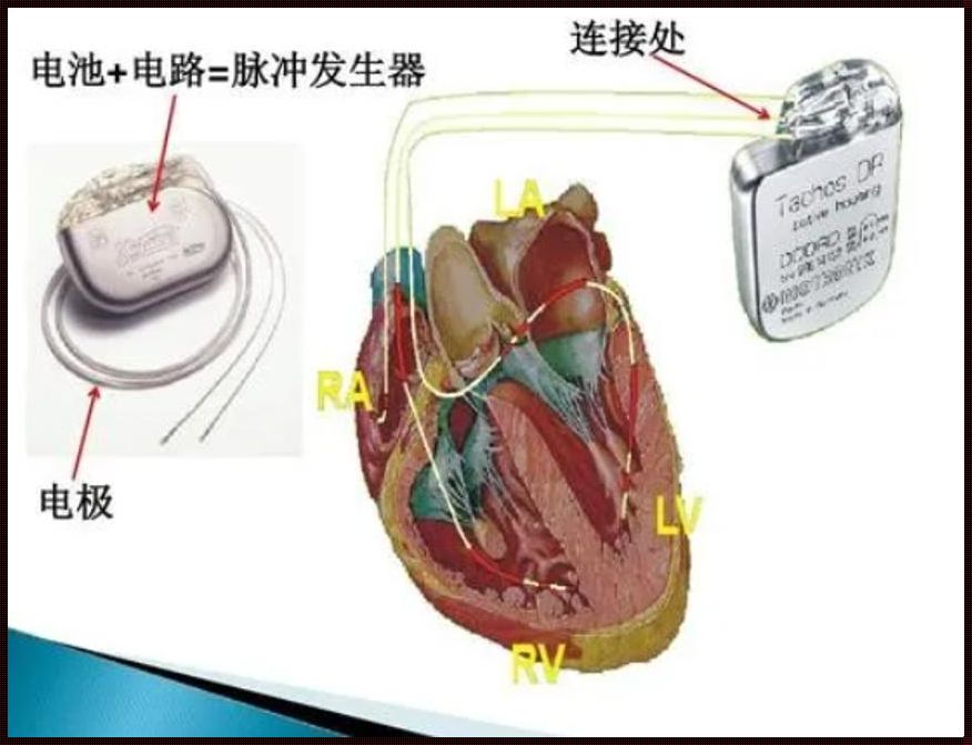 为什么不建议安装心脏起搏器？