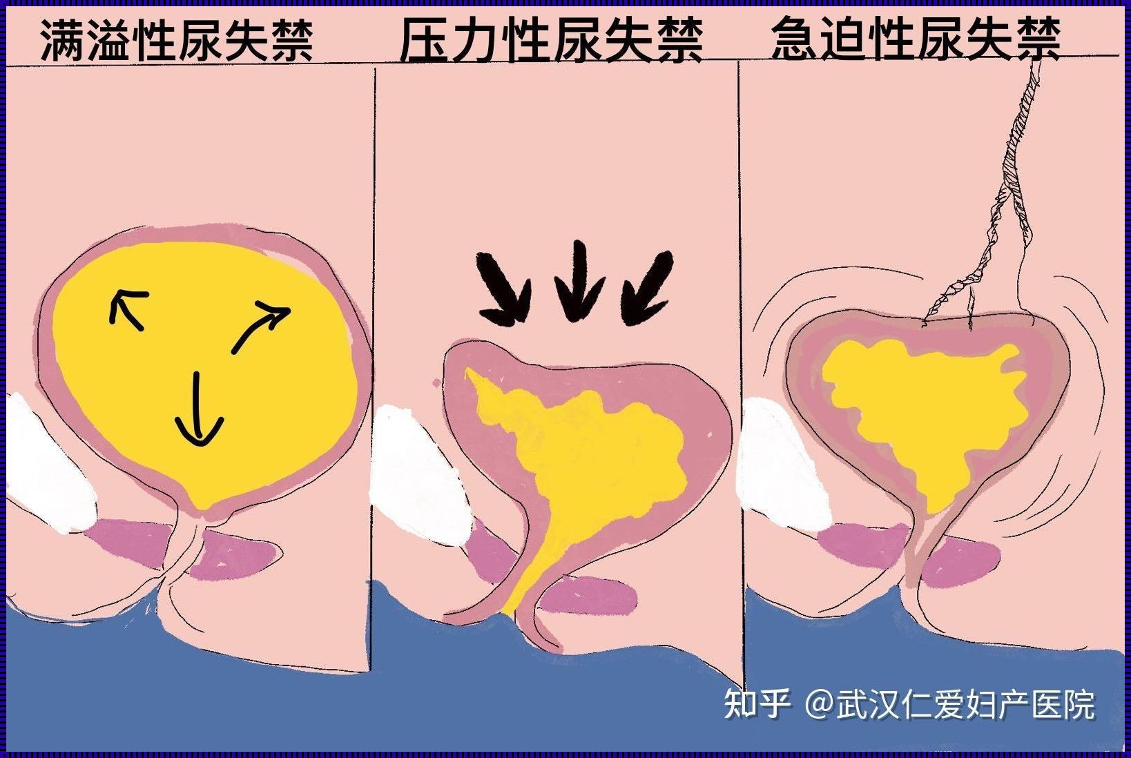 顺产后一辈子都会漏尿吗？