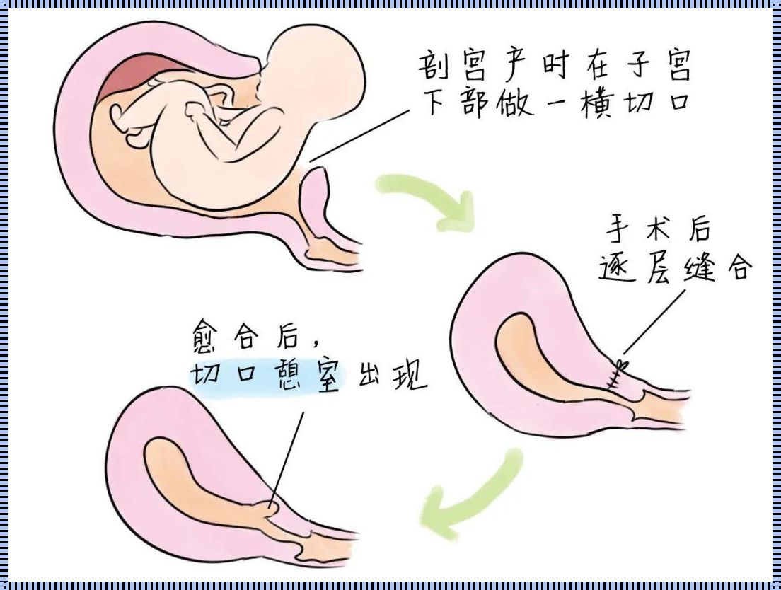 迟到的诊断：剖腹产后12年才查出子宫憩室