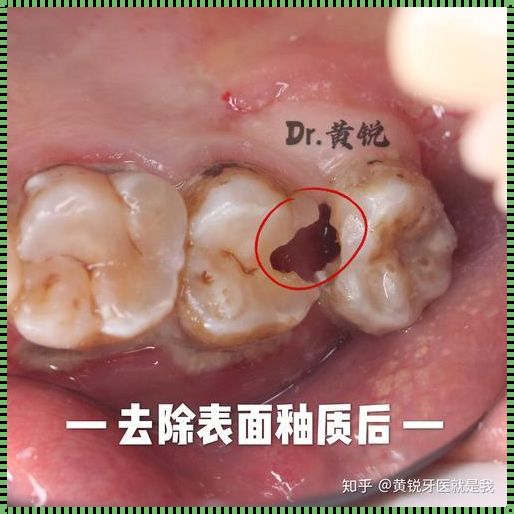 补完的牙冷热刺激会疼正常吗？深入解析与个人体验