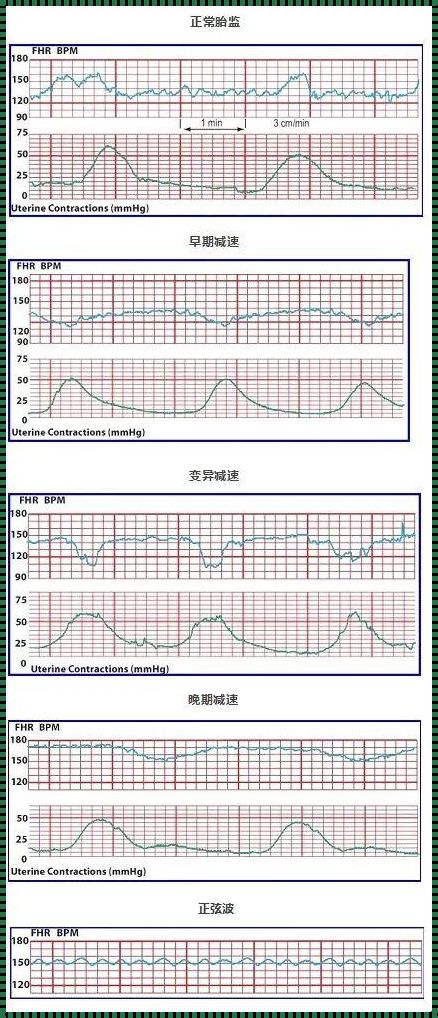 唤醒宝宝：胎心监护的艺术