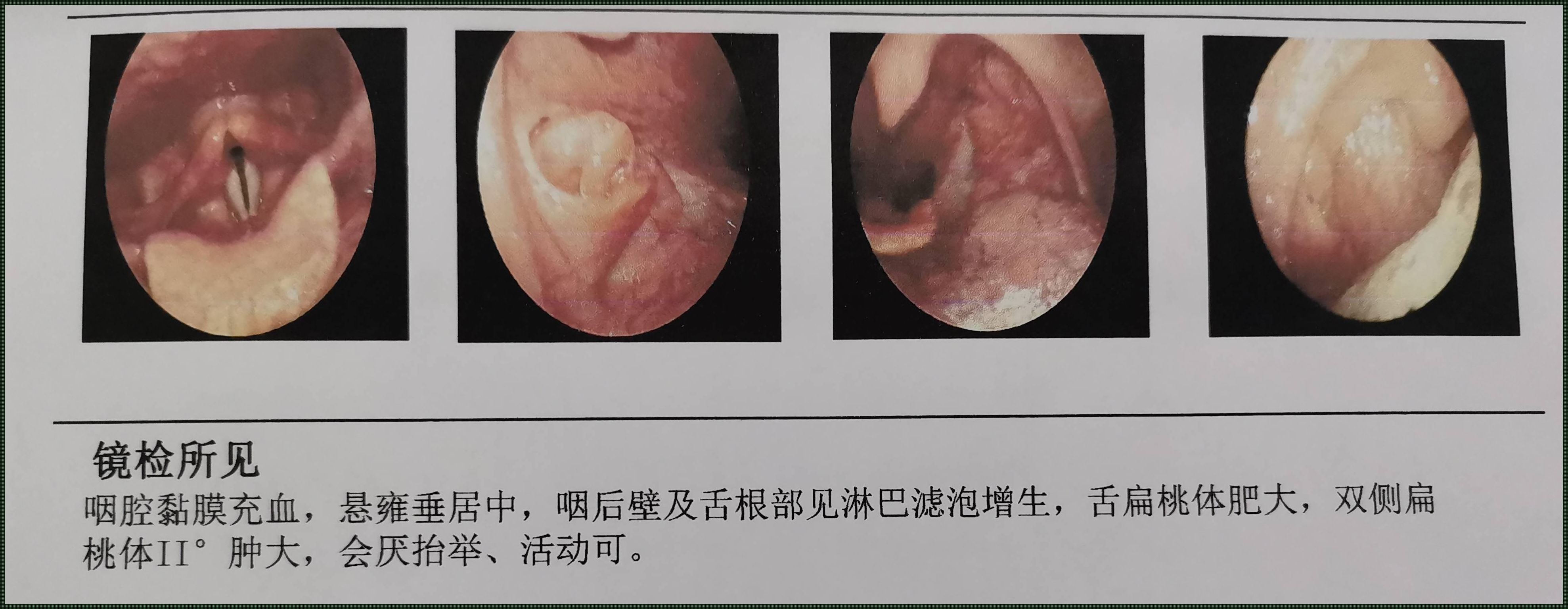 揭开神秘面纱：咽部异物感的背后