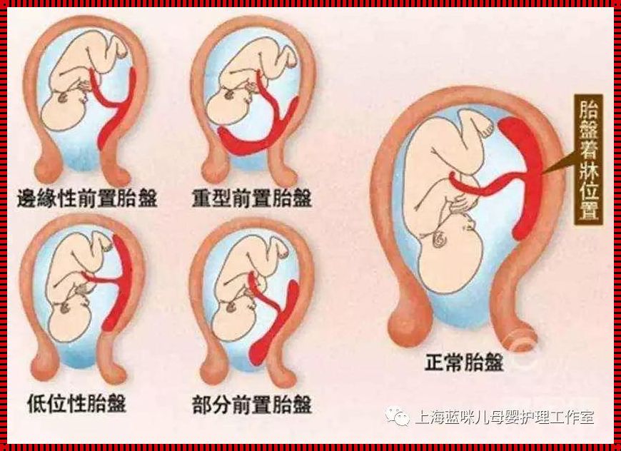 37周胎盘成熟度I—II：当生命的大幕缓缓拉开