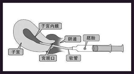 降调人工周期移植冻囊胚流程：探寻生命奇迹的奥秘