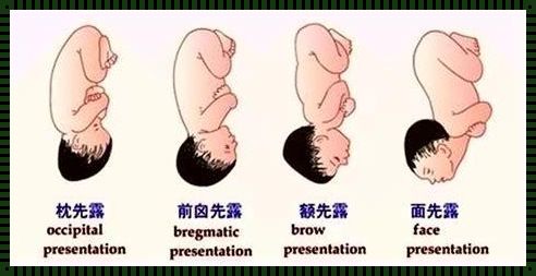 晚秋的期盼：22周羊水少宝宝存活率