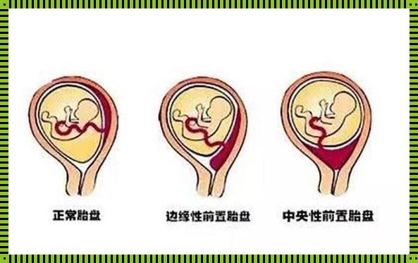 孕39周胎盘1级+还有多久才生产