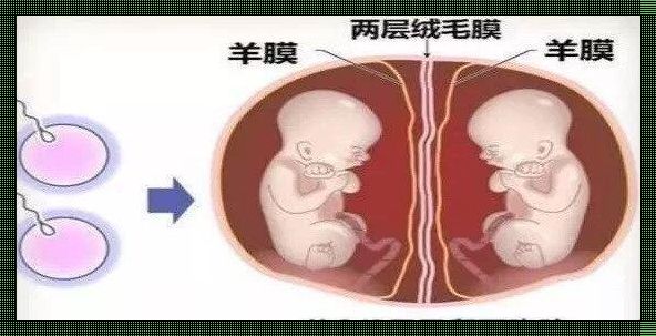 单卵双胎：美好还是负担？