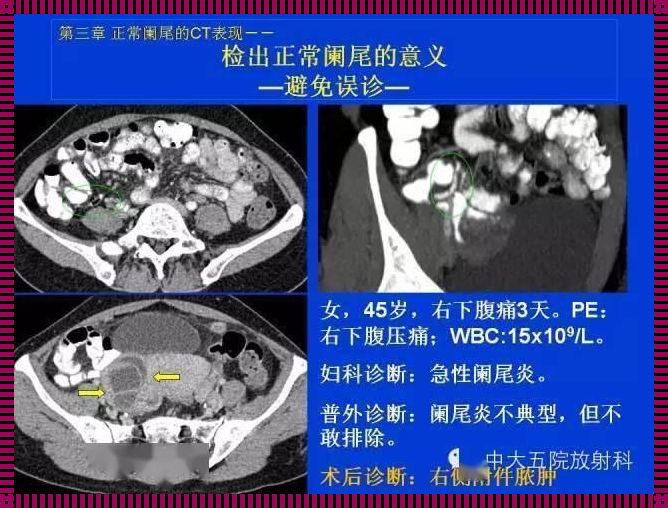 探究腹部CT看阑尾的技巧