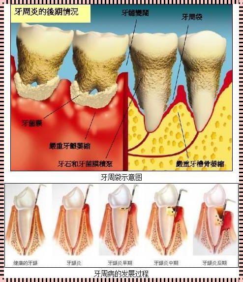 牙周炎最坏的结果：难以承受之痛