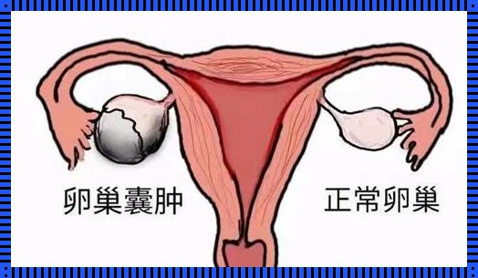 卵巢活检高度病变：深入解析与情感共鸣
