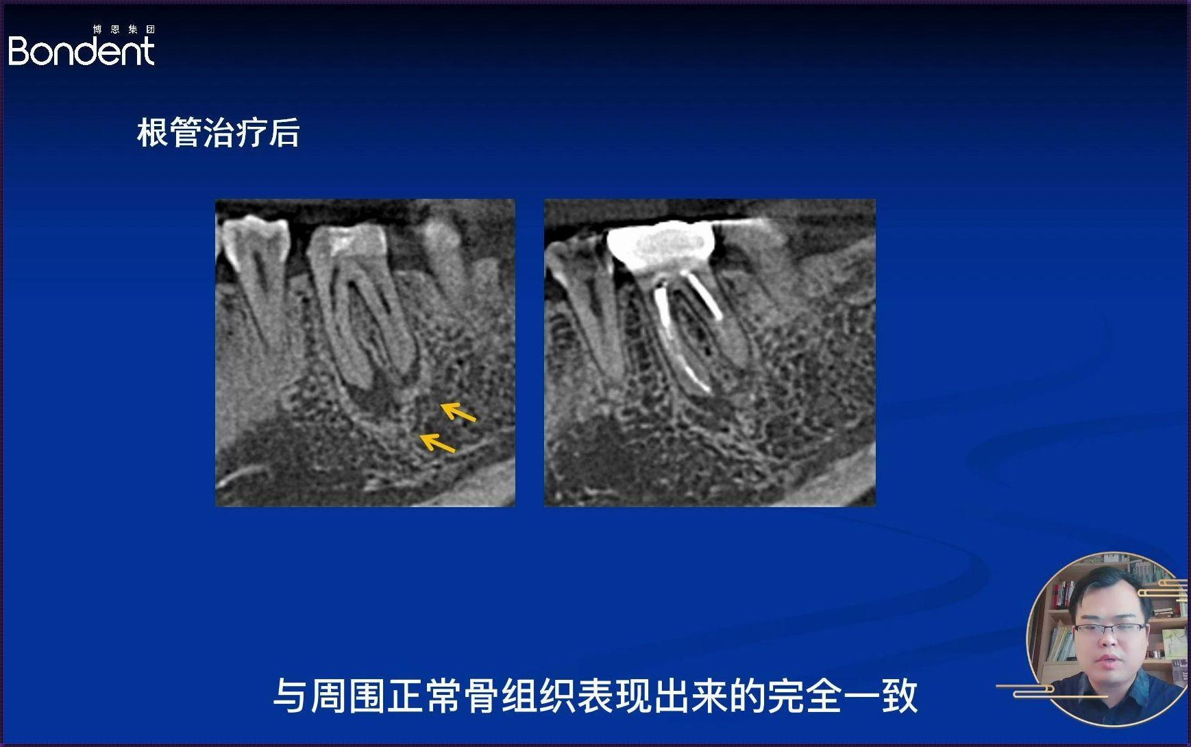 致密性骨炎会发展成强直吗？揭秘骨肉之疾的演变之路