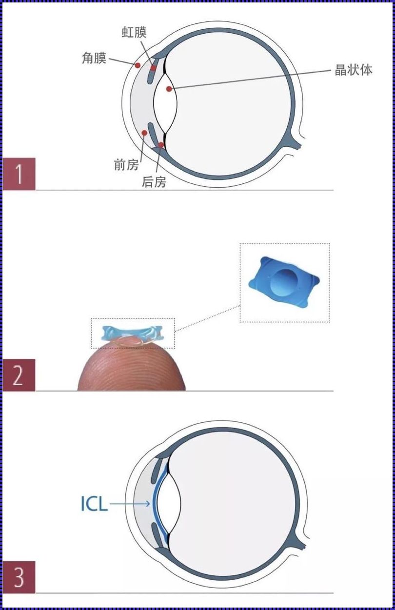 深入解析ICL晶体植入手术原理：利与弊的权衡