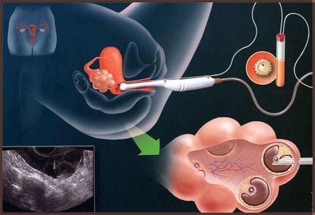 试管取了2个卵泡配了1个：揭秘