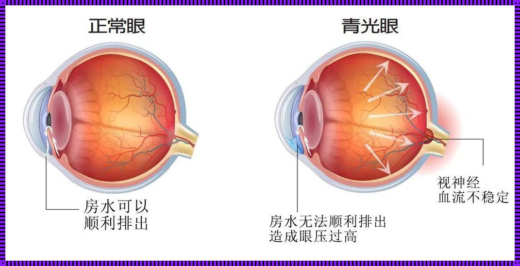 判断青光眼最简单方法