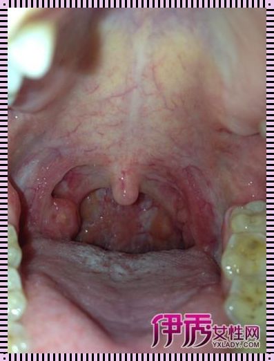 喉咙滤泡增生：症状、原因及治疗探究