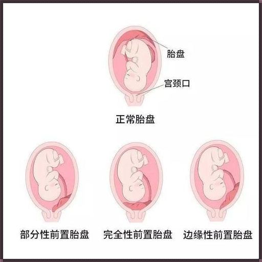 怀孕36周胎盘二级：深度解析与关注