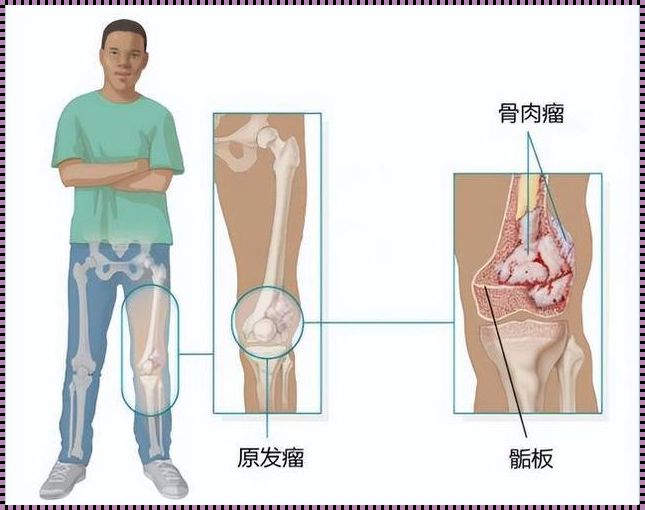 骨癌最先疼痛部位：揭秘