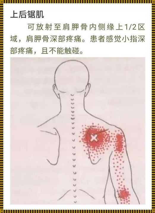 肩膀疼痛的位置图解析