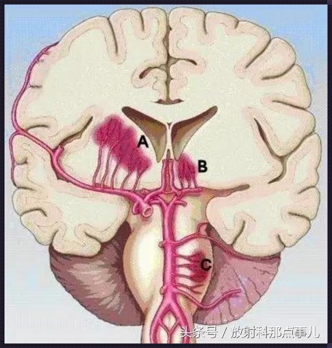 大部分顺产儿都有轻微脑出血：历史与现状的深度探讨