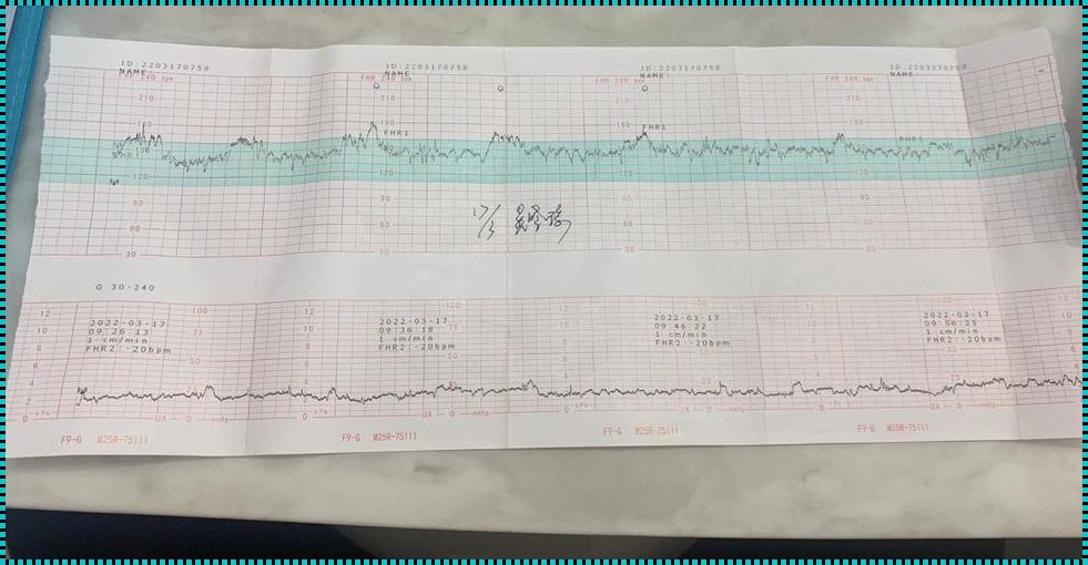 32周零3天胎心监护可以做吗