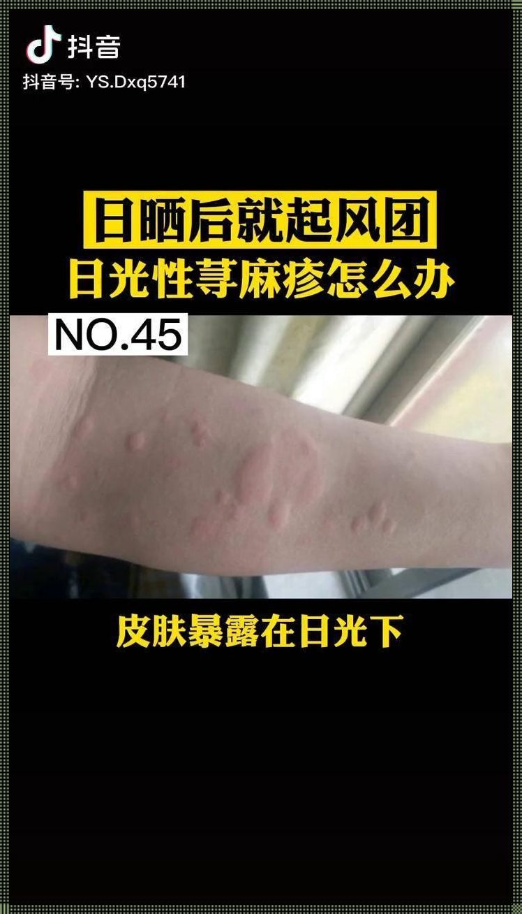 荨麻疹医院怎么治疗：寻求专业医疗的帮助