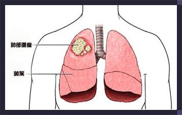 肺癌的早期症状和前兆：揭开神秘面纱