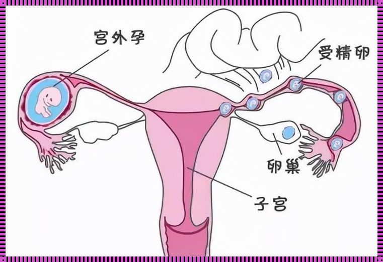 宫外怀孕了打掉的方法：深入探究与心灵关怀