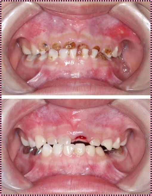 6岁儿童大牙已经全烂掉还会长吗？揭秘