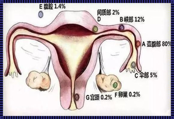 宫外孕三个洞和四个洞的区别