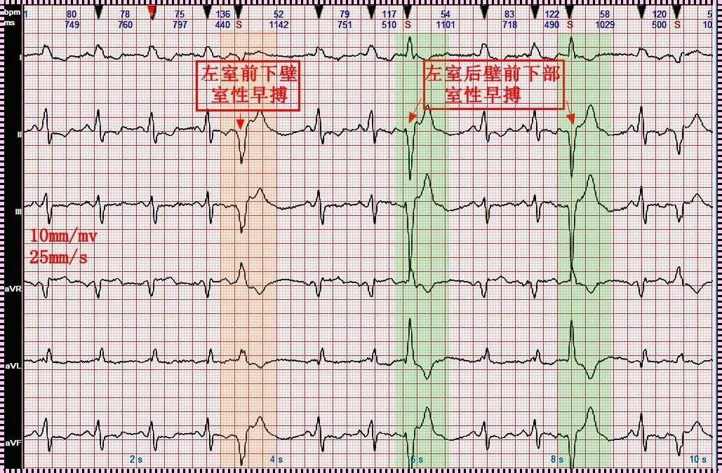 6岁儿童早搏无症状严重吗