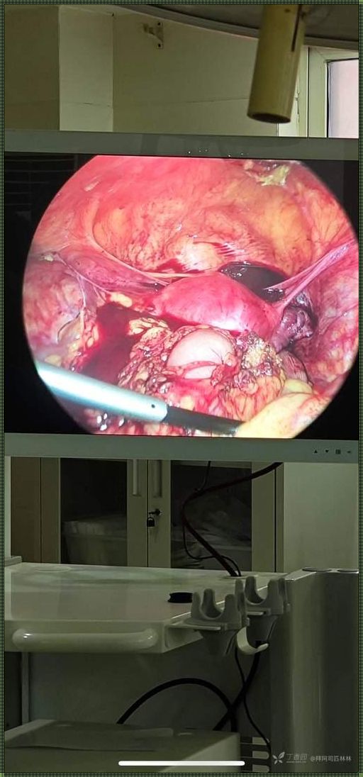 输卵管发炎化脓一定要手术切除吗？寻求答案的旅程