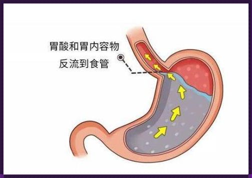 探究食道炎的感觉：疼痛与不适的背后