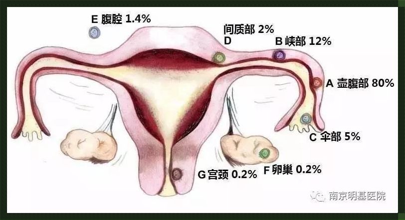 一直宫外孕会可能正常怀孕吗？