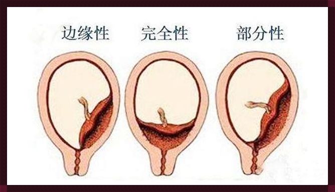 怀孕8周怎么流产伤害最小