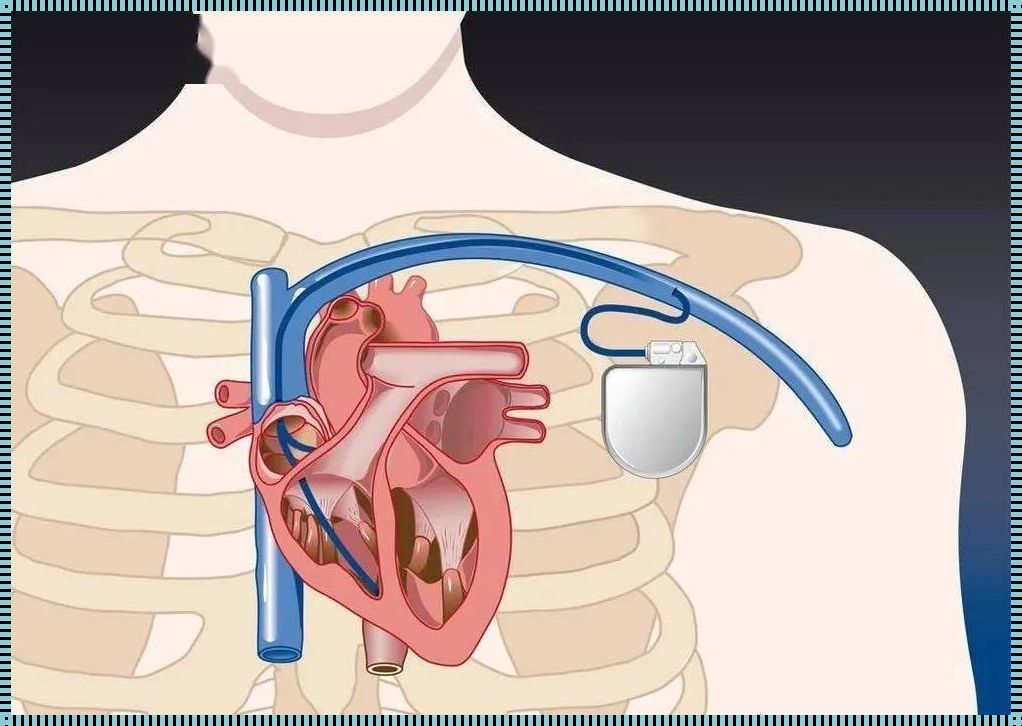 后悔装了起搏器：一位患者的真实分享