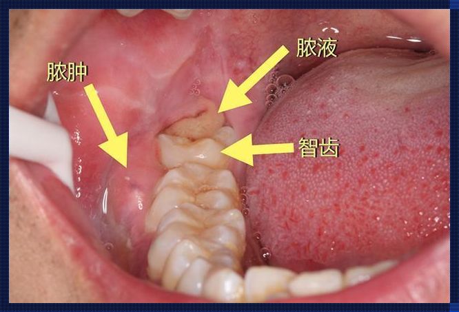 怀孕期间智齿发炎肿痛，怎么办？