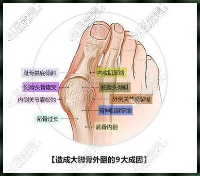 骨外翻是什么原因造成的