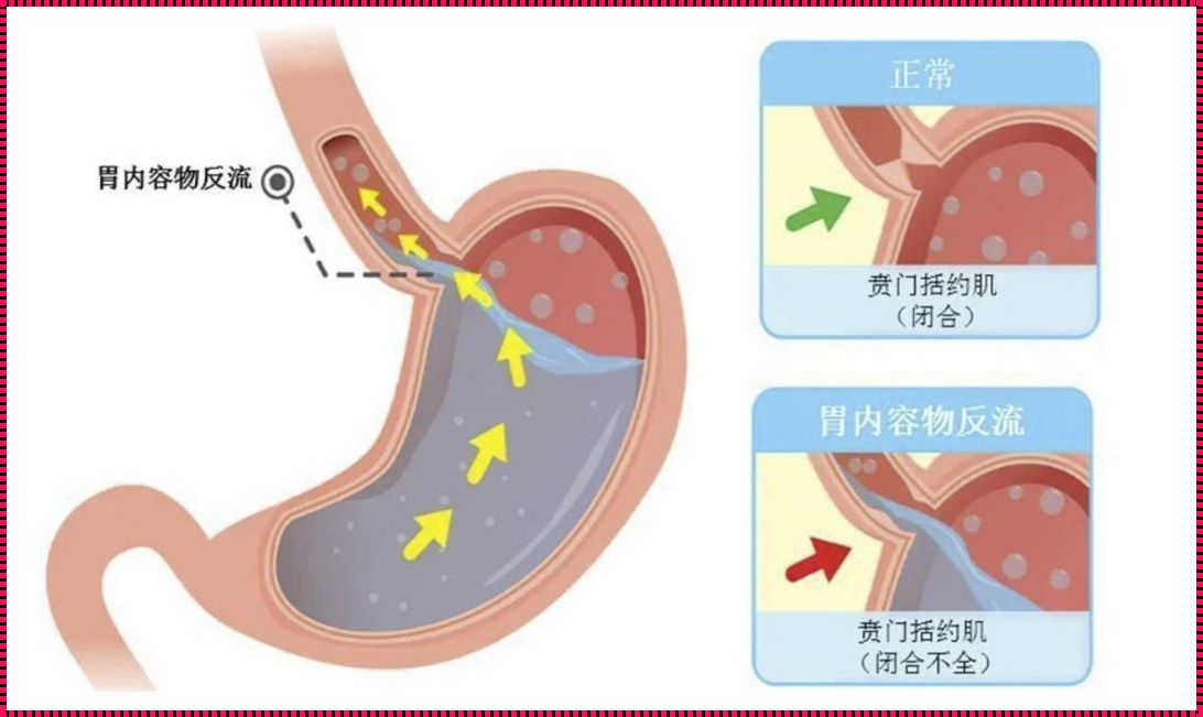 食道被食物堵住了怎么办？