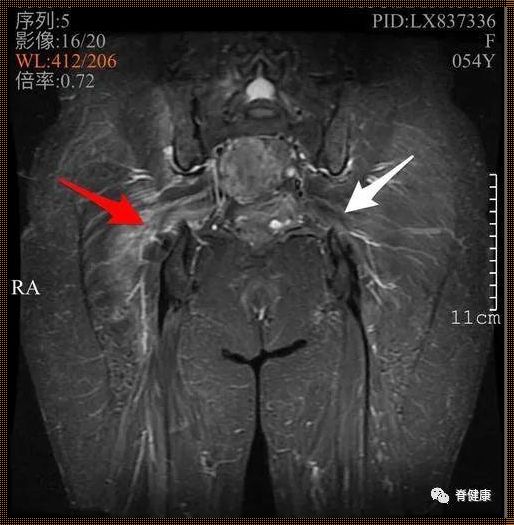 骶骨痛可以自愈吗？探索教育在其中的角色