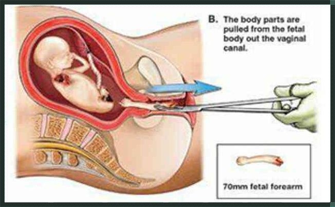医院如何处理引产胎儿：一个深刻而敏感的话题