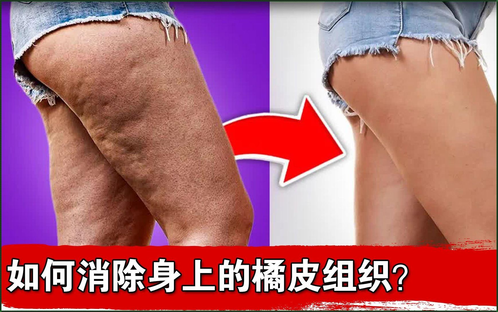 蹲下来大腿有橘皮怎么回事