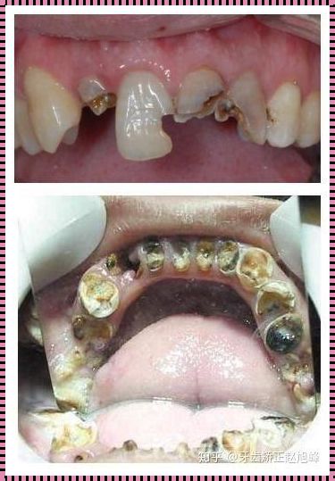 只剩牙根怎么办？解密牙科治疗的多种选择