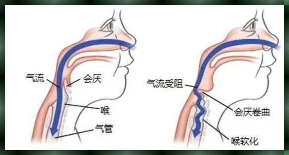 宝宝喉软骨发育不良怎么办