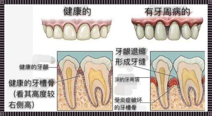 牙龈萎缩严重程度图解：揭露牙齿健康的秘密