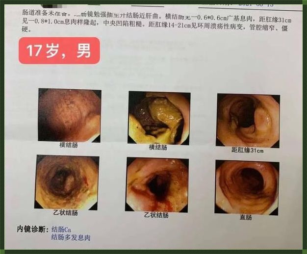 直肠癌能检查出来吗？