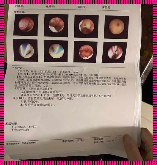 宫腔镜息肉手术需要休息几天：深度解析与探讨