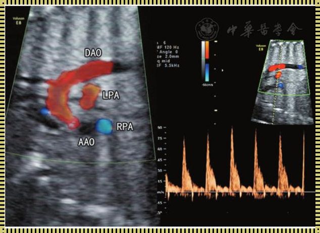 胎儿肺动脉吊带被看错了：一个医疗诊断的失误解析