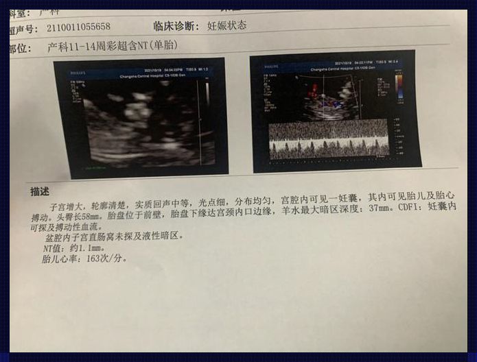 正确孕周以NT为准还是四维